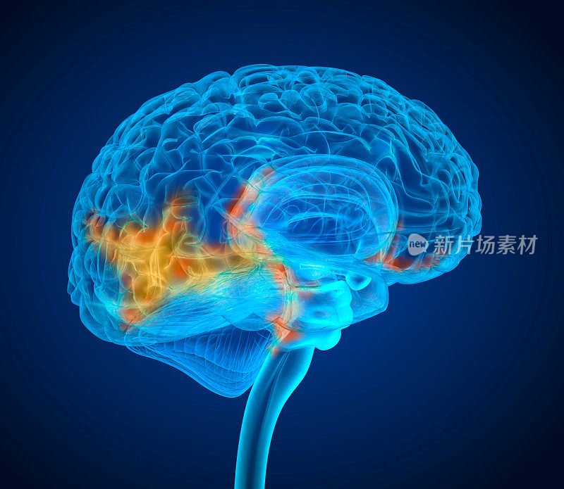 人脑肿瘤x射线扫描，医学上精确的3D插图
