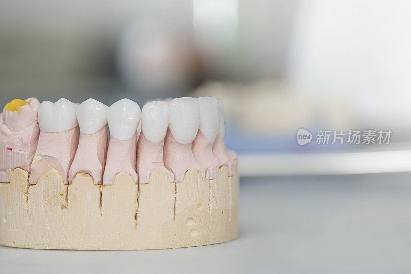 石膏颌上的锆石假牙-陶瓷假牙-