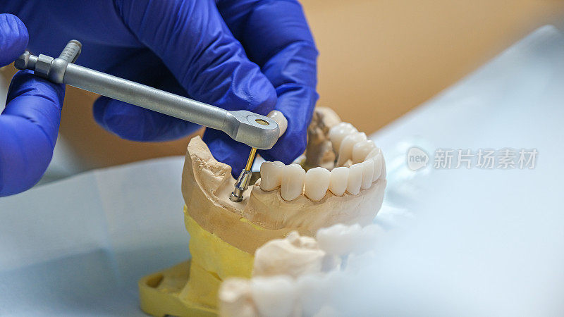 种植牙治疗，种植牙门诊关键特写，氧化锆牙