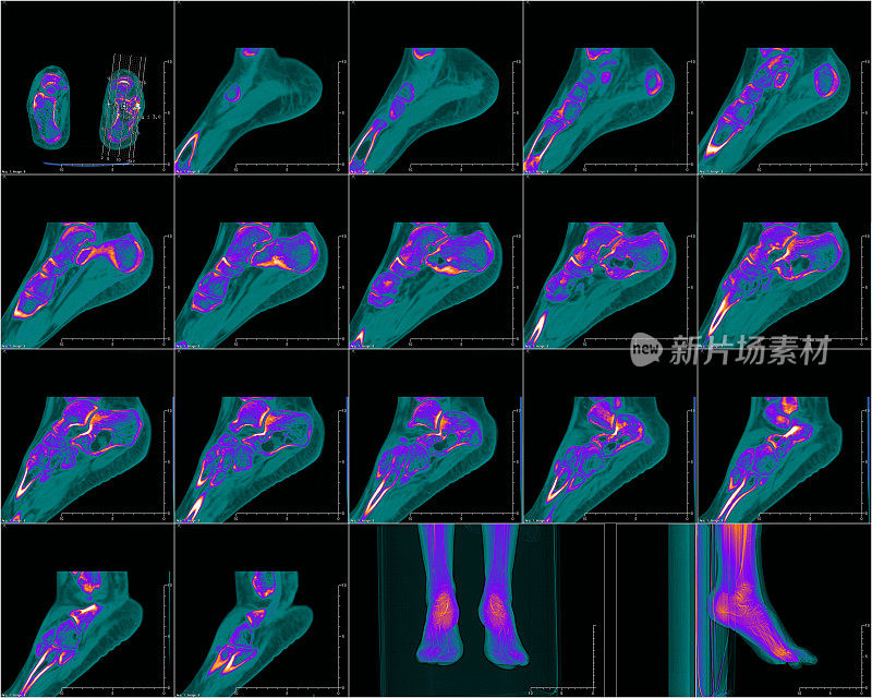 彩色CT足部