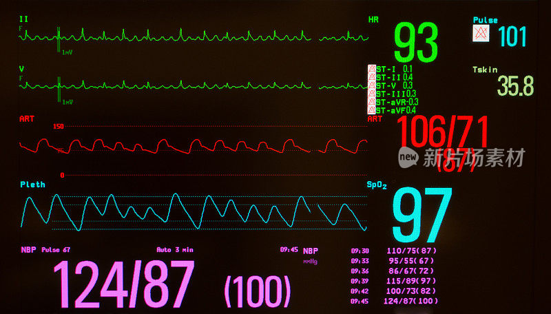 黑屏监护仪上的心房扑动和生命体征