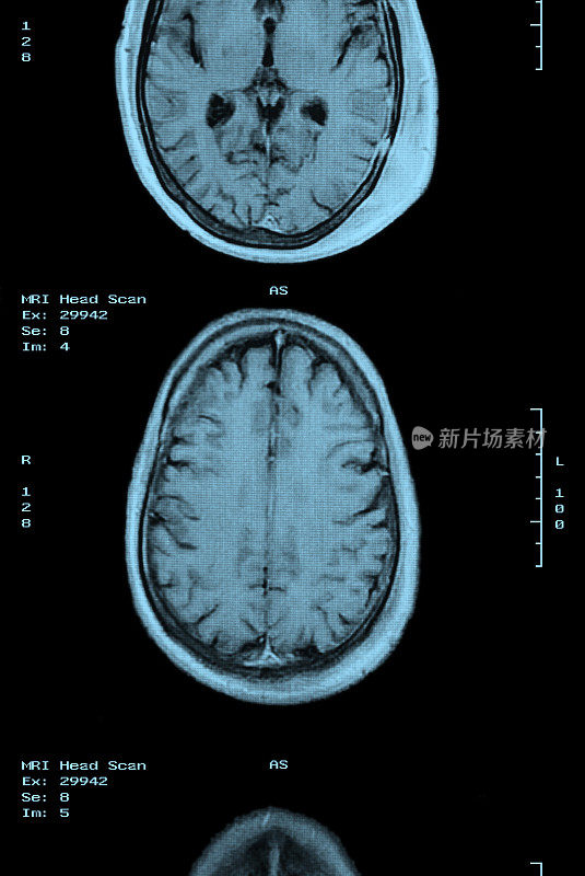 MRI扫描胶片条