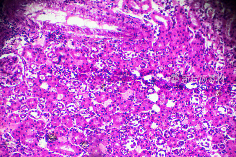 显微镜下急性肾盂肾炎活检标本
