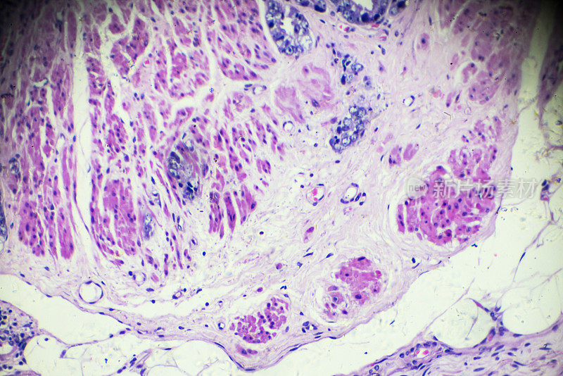 显微镜下前列腺癌活检