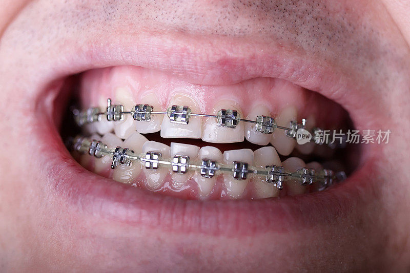 金属矫正牙套对弯曲丑陋的牙齿近距离。丑陋的微笑。牙科概念，医学对齐牙齿，托槽矫正医生