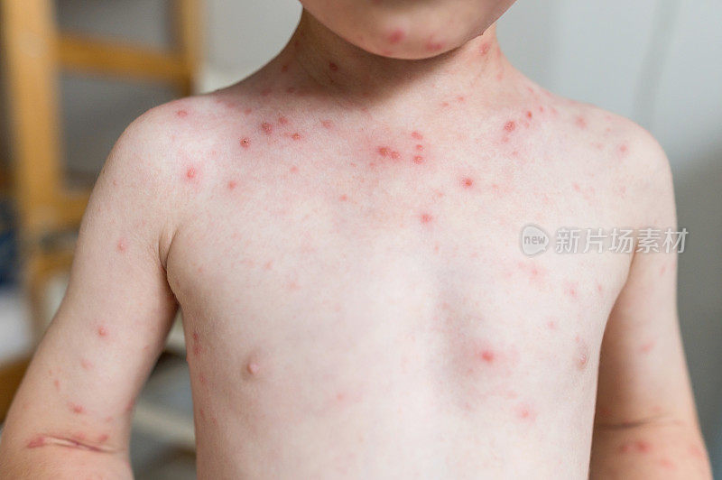 这个小男孩得了水痘，胸部有水疱和结痂