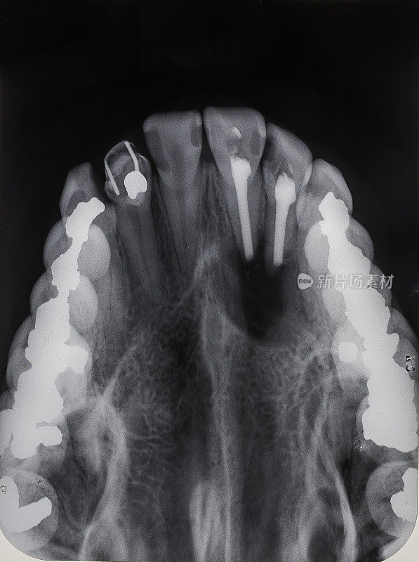 两颗有根管填充物的切牙在上颌根的末端有一个较大的根尖周围病变。