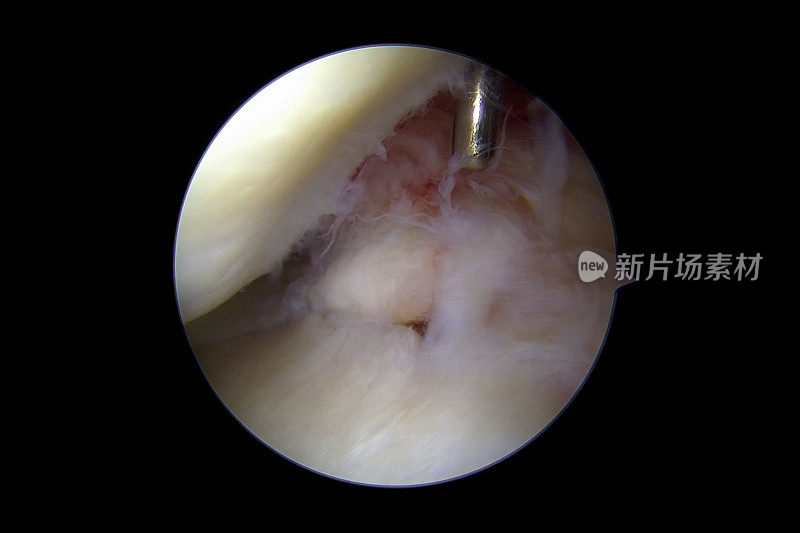 后半月板根骨撕脱性骨折