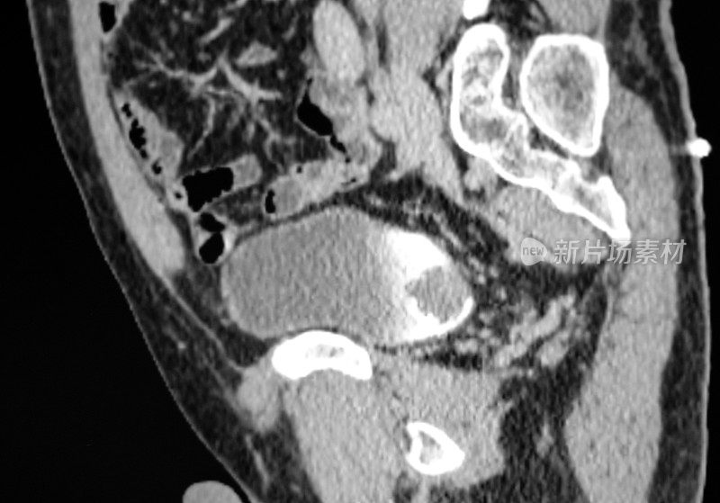 膀胱癌的CT影像