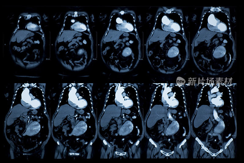 胸腹的CT