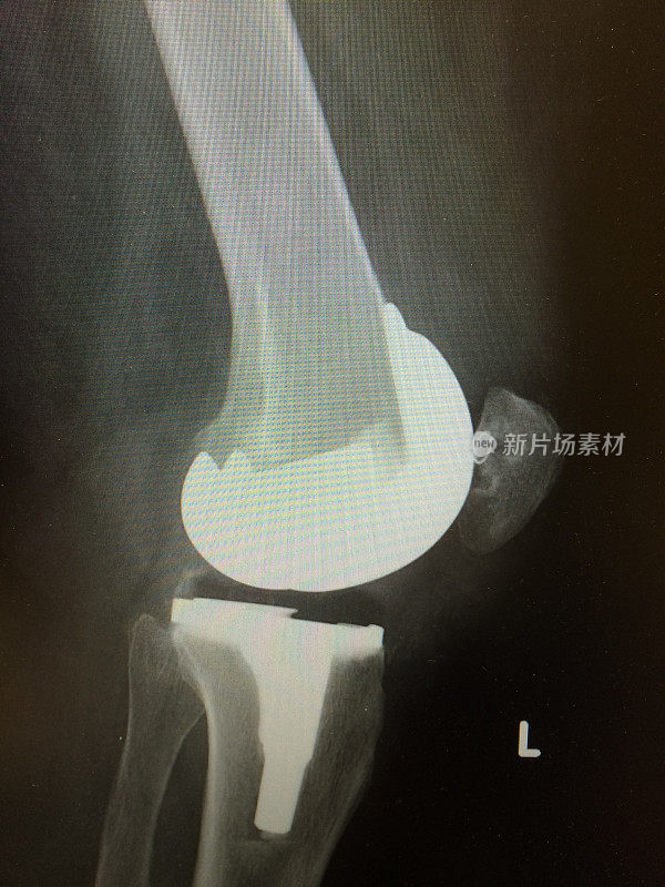 双膝置换术x线片