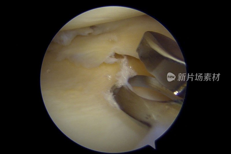 右膝内侧半月板后部皮瓣撕裂的关节镜观察