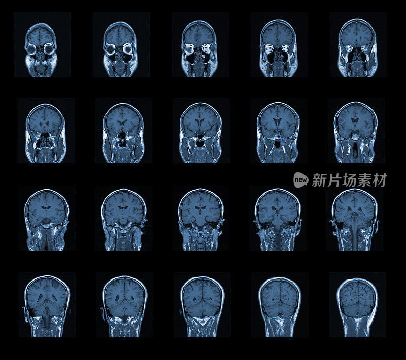 核磁共振头部扫描