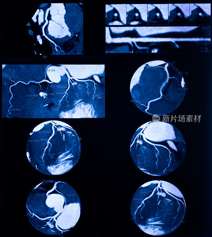 冠状动脉造影的多探测器计算机断层扫描