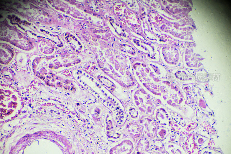 显微镜下急性肾炎活检标本