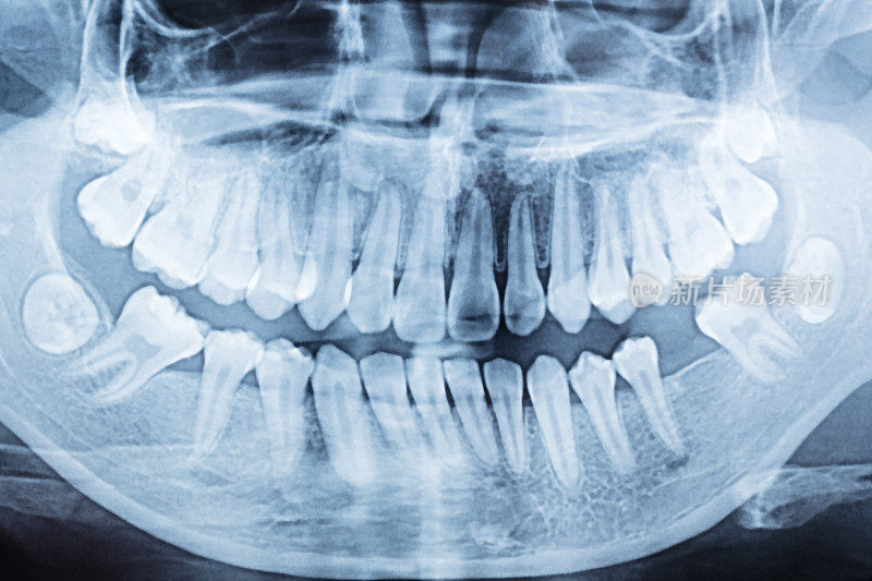 牙齿x光片。