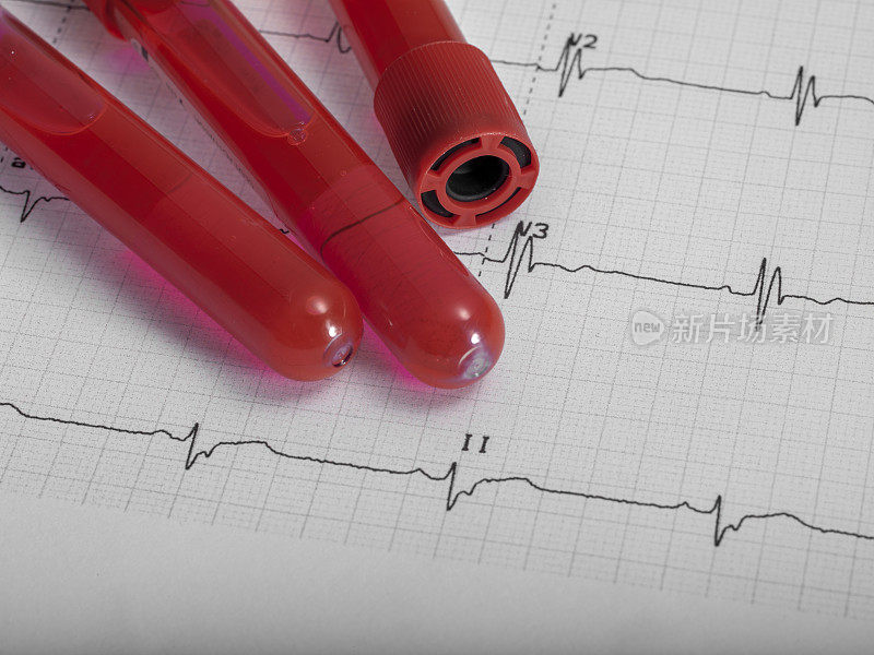 真实心电图和新型冠状病毒血试管没有人。