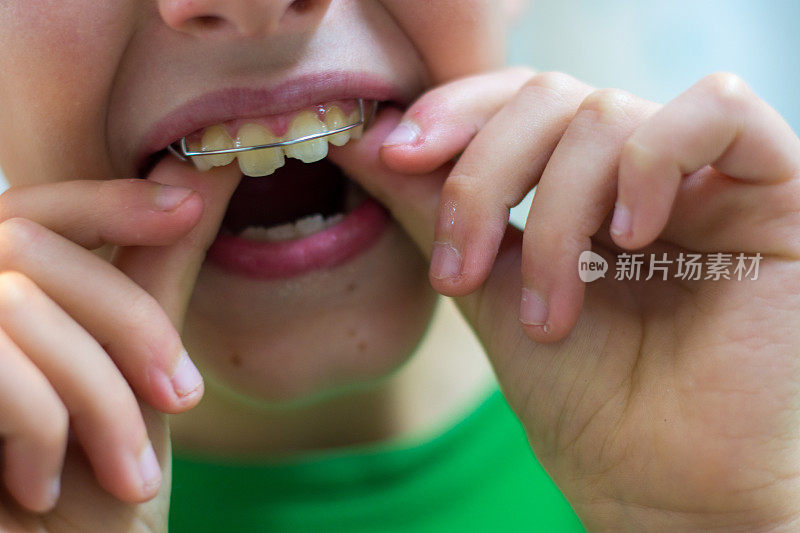 一个孩子戴上牙套，把牙套抱在怀里。牙医和正畸医生的概念