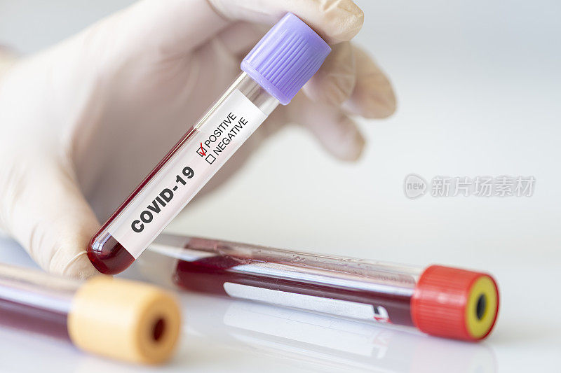 冠状病毒血液检测。实验室冠状病毒阳性血液