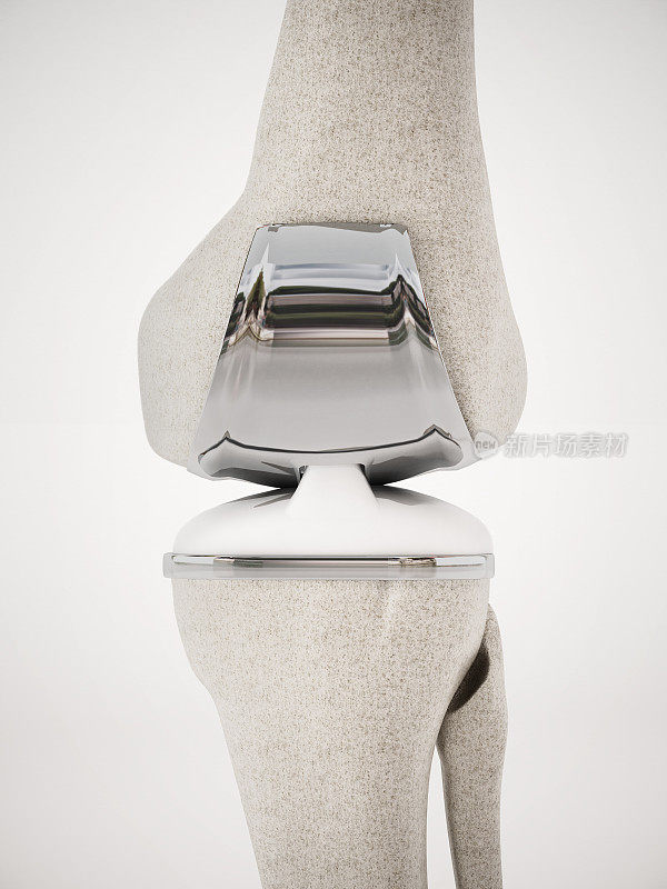 膝关节置换与植入的3D插图