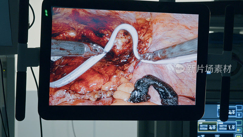医疗机器人。腹腔镜腔内手术监视器的特写镜头，腹腔