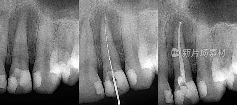 牙科x光片治疗前后