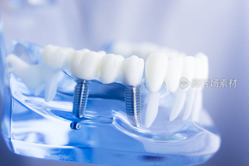 牙科学生学习教学模式展示牙齿、牙根、牙龈、牙龈疾病、蛀牙和牙菌斑。