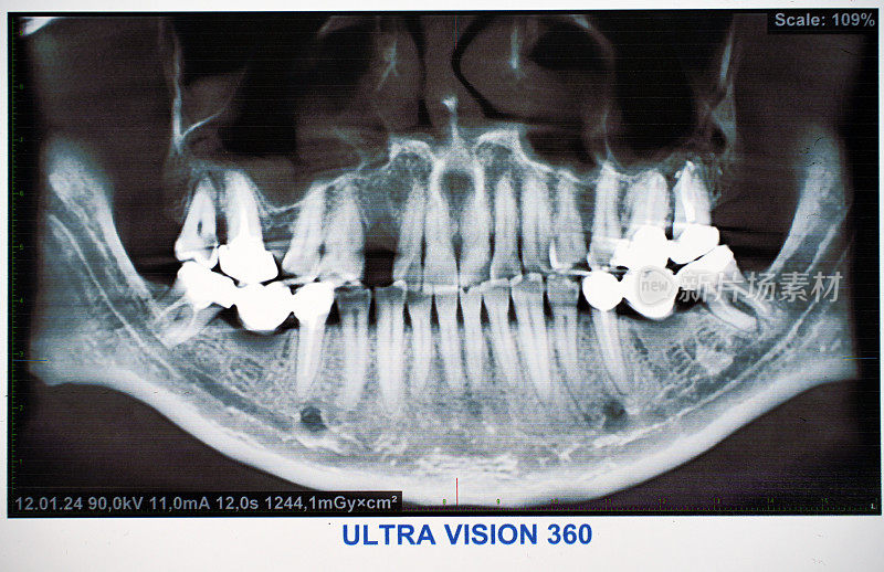 牙齿断裂的全景牙科x光片