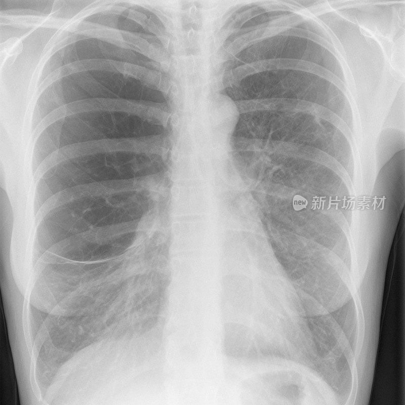一个患有肺气肿的吸烟者的数字胸部x光片