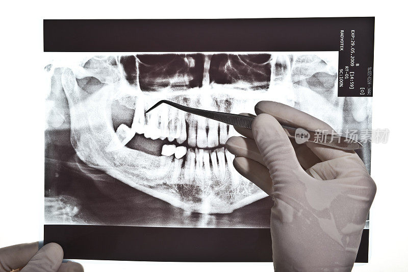 牙科X射线