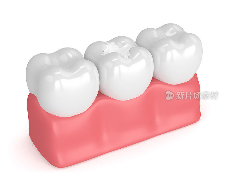 牙齿的3d渲染与牙科复合填充