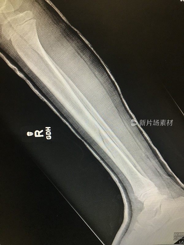 腿部胫骨骨折x线照片