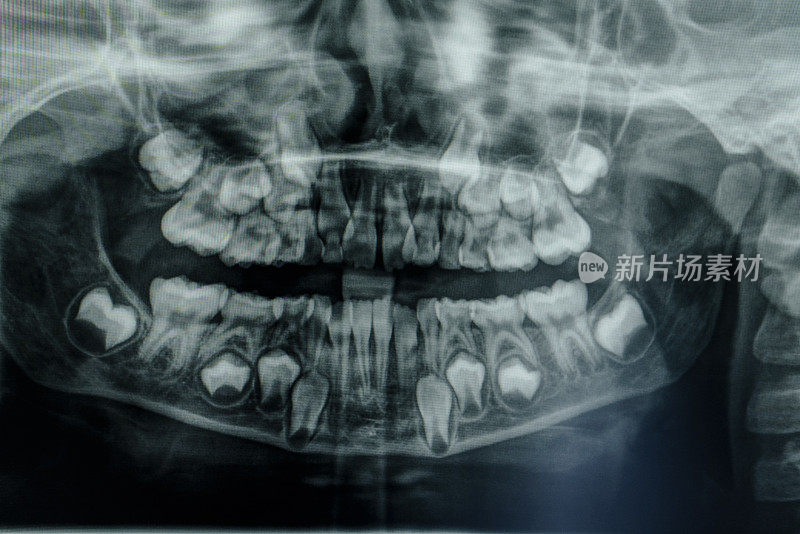 7岁儿童缺牙的牙齿x光片