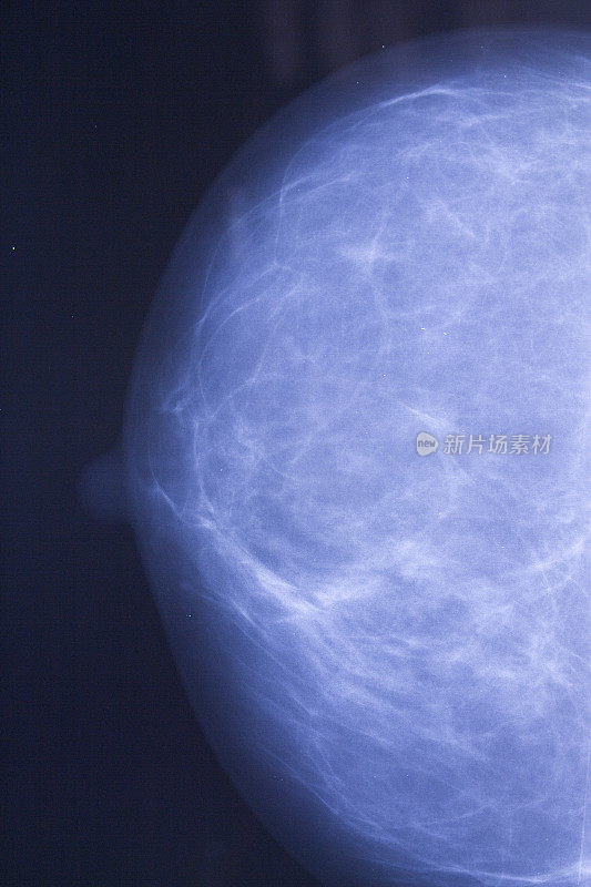 乳房肿瘤x光片