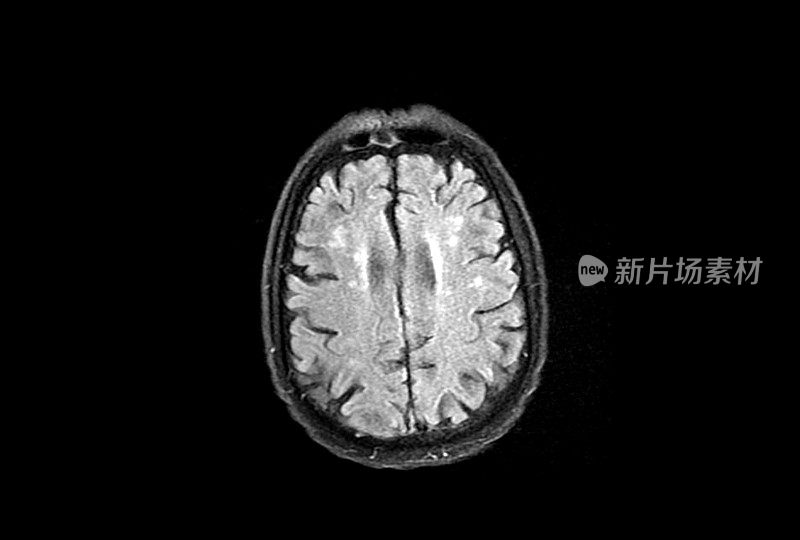 大脑核磁共振图像