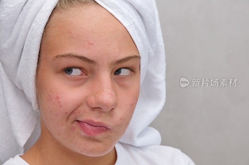 一个十几岁的女孩扭曲了她的脸，她不喜欢，因为痤疮。粉刺。