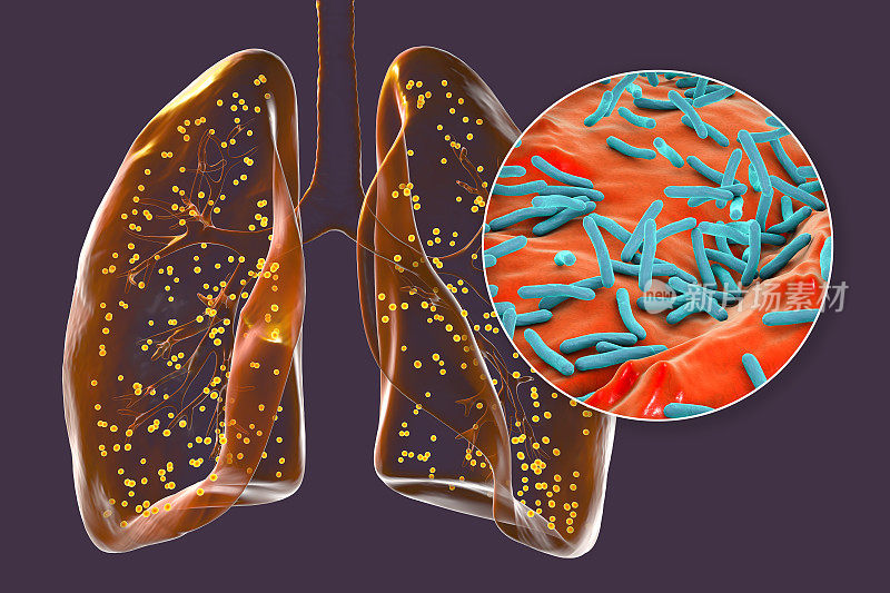 受军旅结核影响的人肺，以及结核分枝杆菌的特写，三维插图