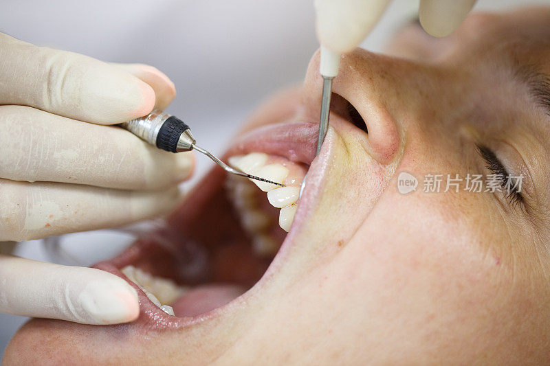 测量牙周袋深度的牙周探针