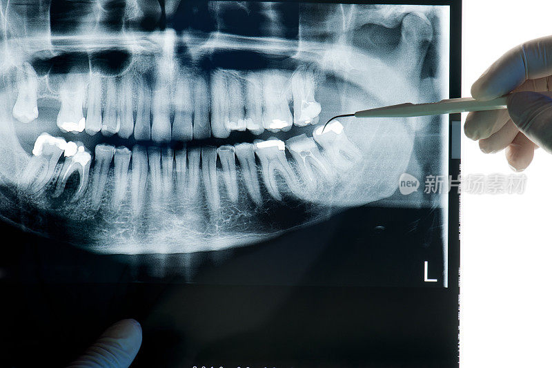 牙医检查x射线