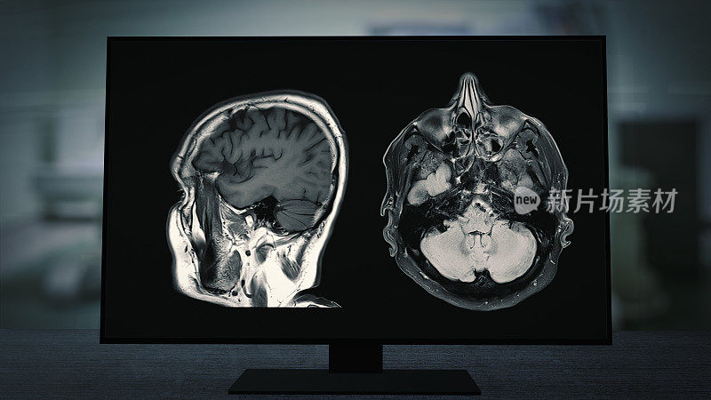 CT脑部扫描图像的磁共振成像(MRI)监视器