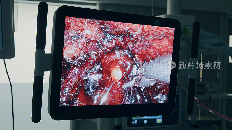 缝制阶段。医疗机器人。腹腔镜腔内手术监视器的特写镜头，腹腔