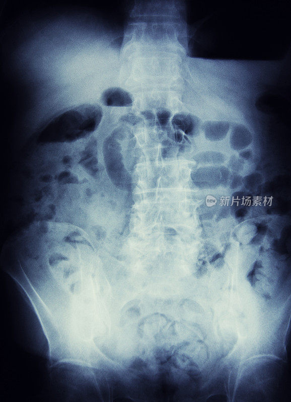 x射线的肠梗阻