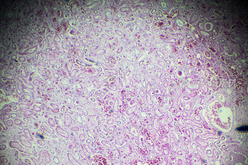 显微镜下急性肾炎活检标本