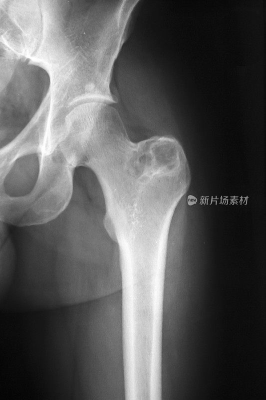 x光片显示髋部骨软骨瘤
