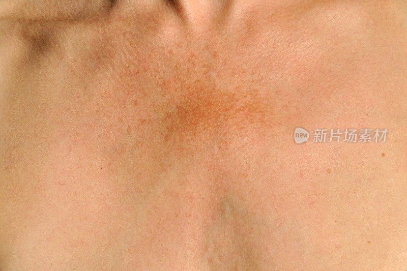 黄褐斑:皮肤色素沉着障碍