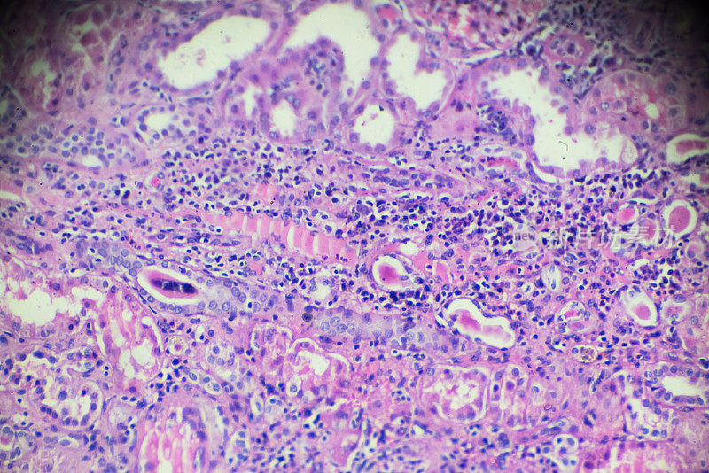 光镜下慢性肾盂肾炎活检