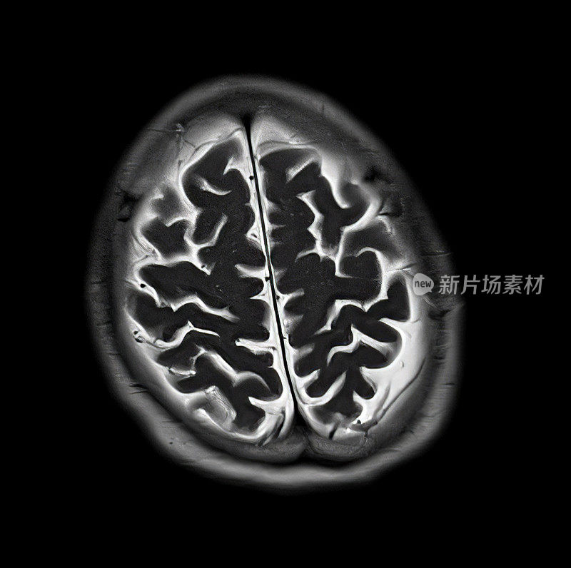 磁共振成像脑部扫描图像(MRI)