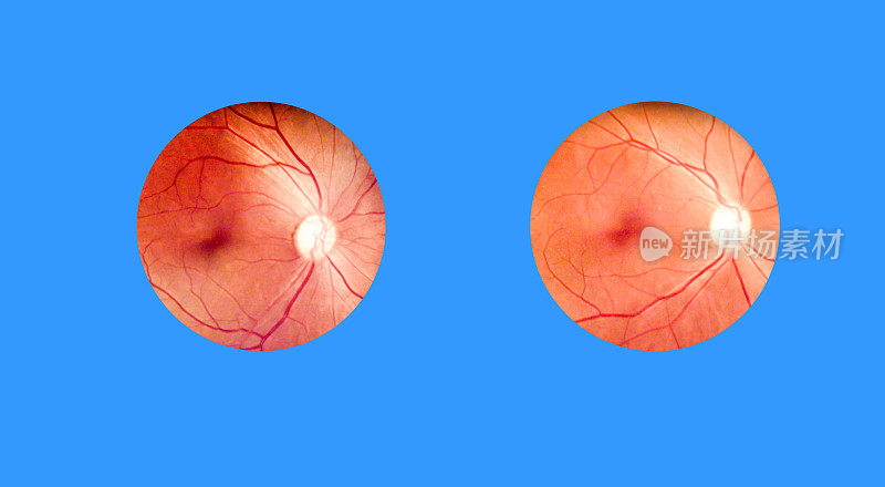 老年糖尿病视网膜患者。用瞳孔视网膜相机拍摄人眼解剖图像。