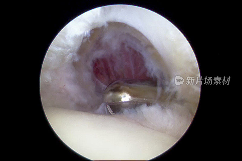 关节镜下观察肩膀肌腱套中度大的u型撕裂