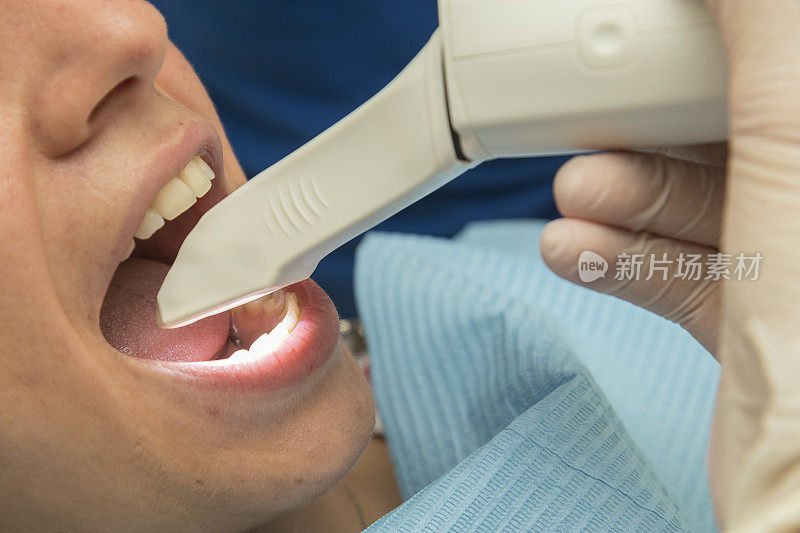牙医嘴扫描仪